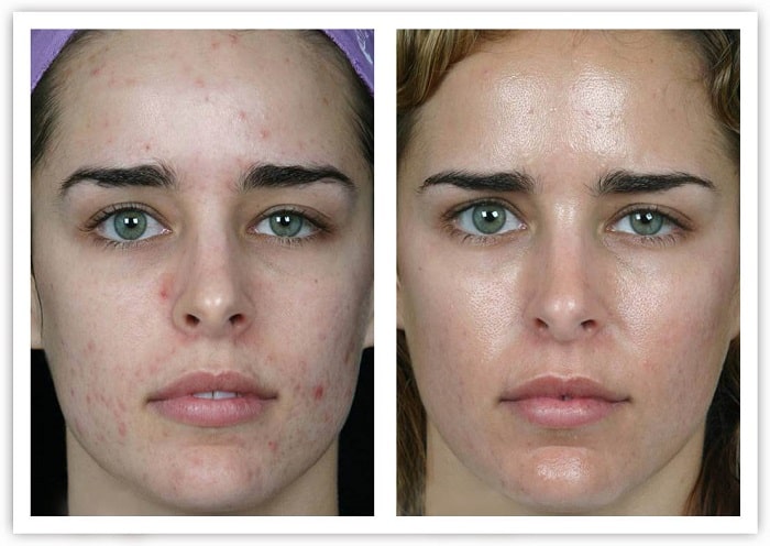 Чистка лица у косметолога: фото до и после